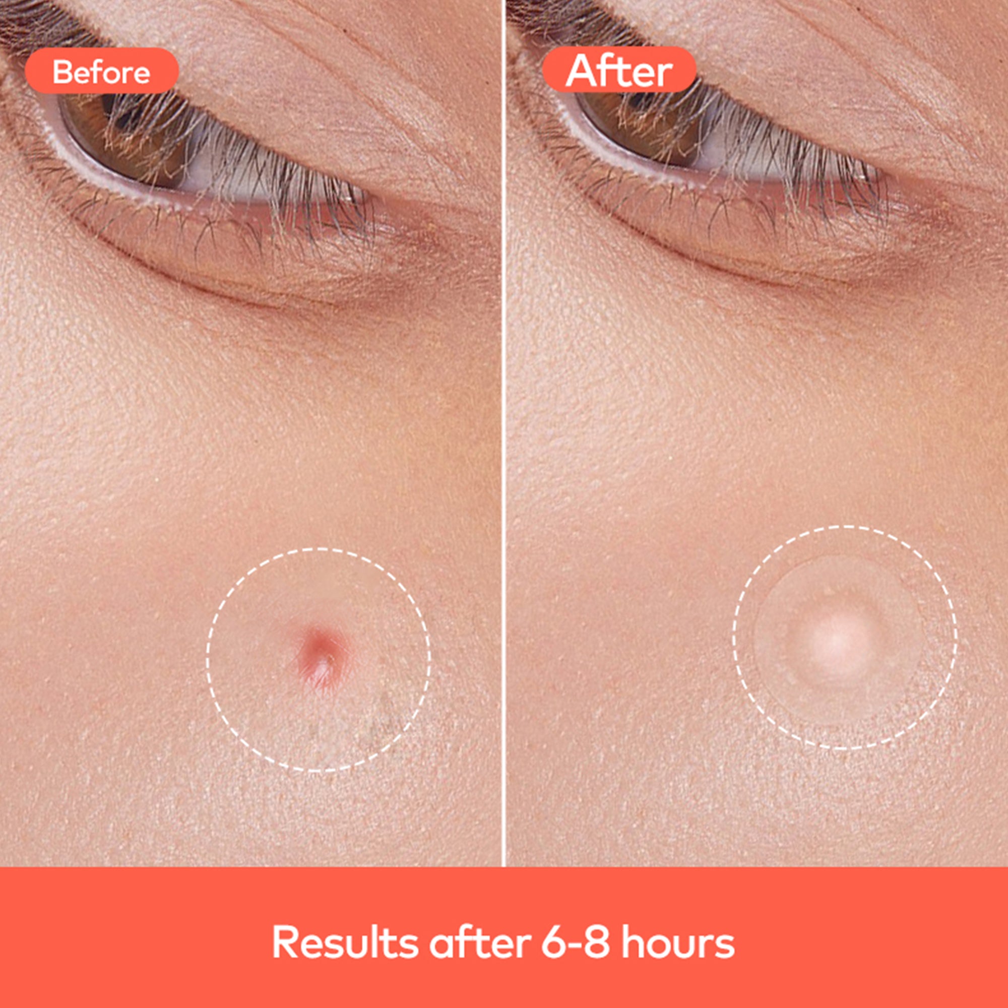 Hydrocolloid Acne Pimple Patch